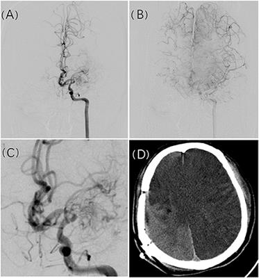 Postoperative cerebral infarction after revascularization in patients with moyamoya disease: Incidence and risk factors